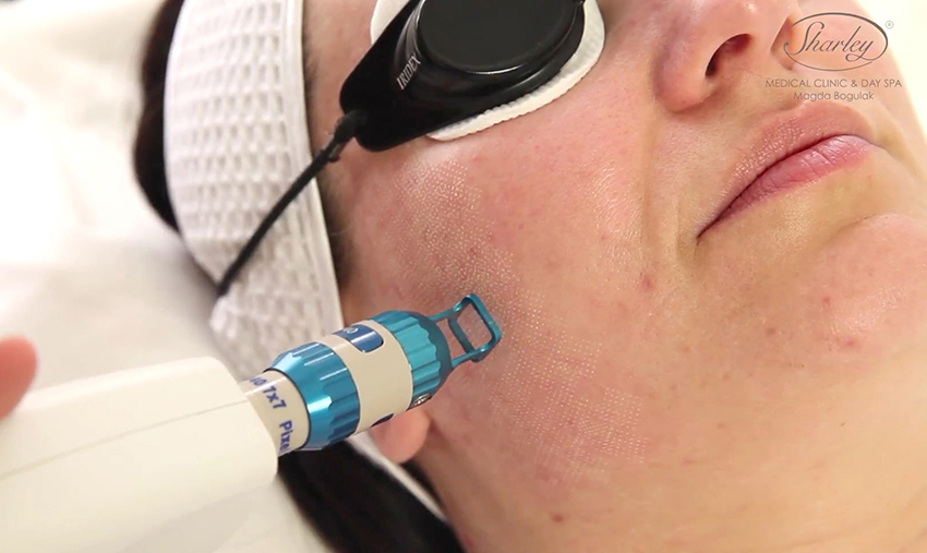 regeneracja skóry twarzy laserem